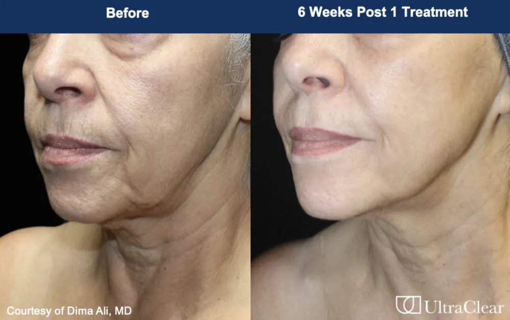Before and after treatment result at DrSkinB Aesthetics