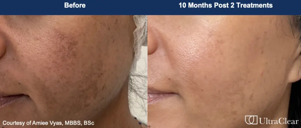 Before and after treatment result at DrSkinB Aesthetics