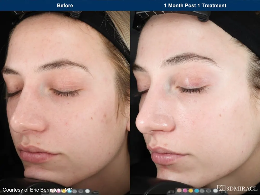 Before and after treatment result at DrSkinB Aesthetics