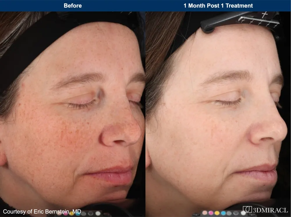 Before and after treatment result at DrSkinB Aesthetics