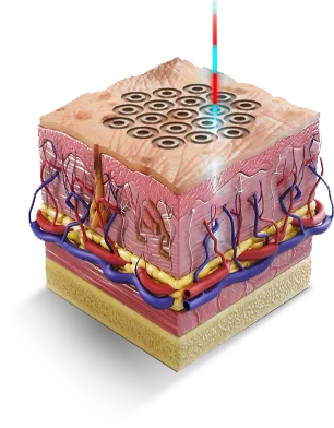 Diagram of UltraClear laser-coring channels resurfacing the skin surface